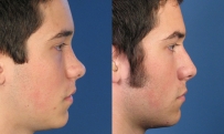 2406 Saddle Nose Deformity