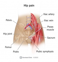 2507 Hip pain